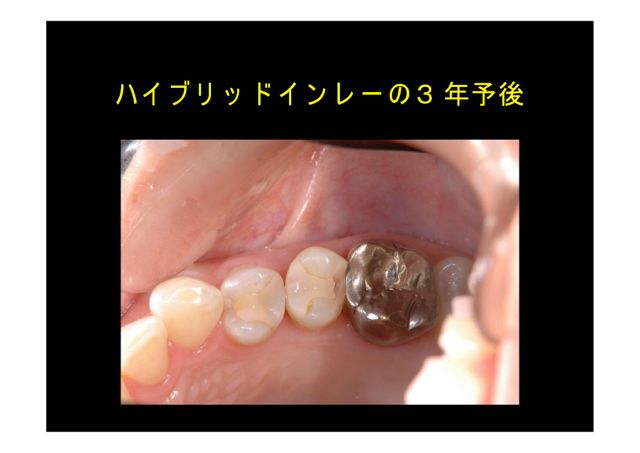 ハイブリッドセラミックス破損症例の参考画像